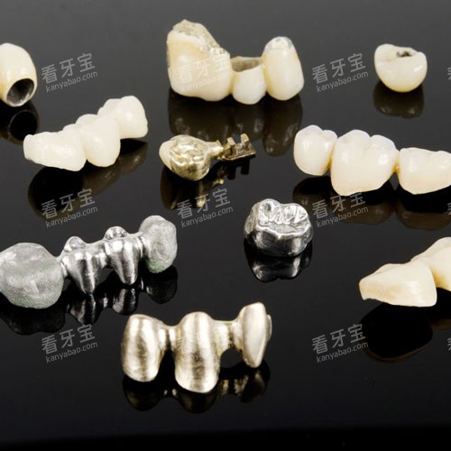 后牙做牙冠必看:烤瓷牙的3个优势与全瓷牙的4大亮点