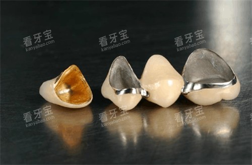 不同材质的烤瓷牙 不同材质的烤瓷牙