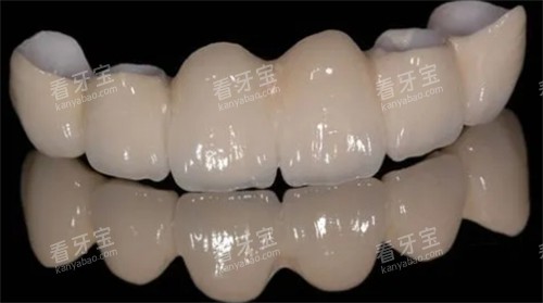烤瓷牙的颜色和光泽 烤瓷牙的颜色和光泽