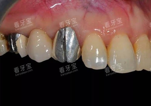 烤瓷牙冠照片 烤瓷牙冠照片