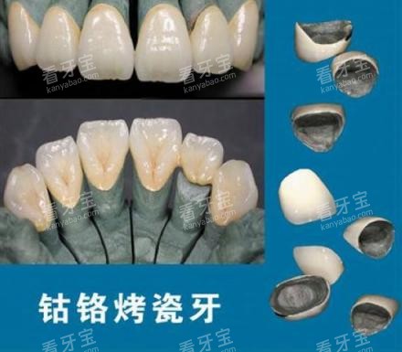钴铬合金烤瓷牙示意图 钴铬合金烤瓷牙示意图
