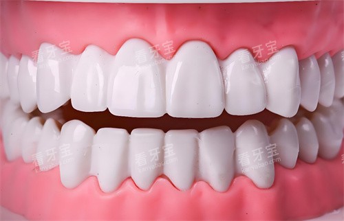 牙齿美白模型 牙齿美白模型