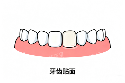 牙齿贴面卡通展示图 牙齿贴面卡通展示图