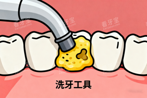 清洗牙齿脏东西展示图 清洗牙齿脏东西展示图