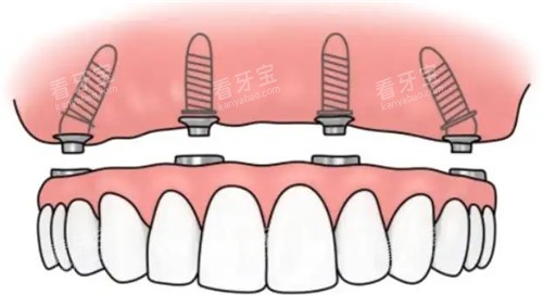 半固定种植牙卡通图 半固定种植牙卡通图