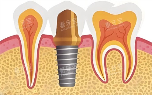 种植牙展示图片展示图 种植牙展示图片展示图