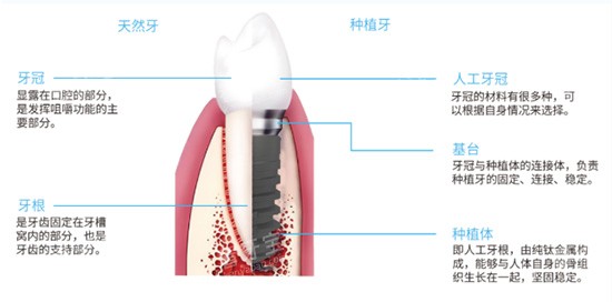 种植牙结构分析图片 种植牙结构分析图片