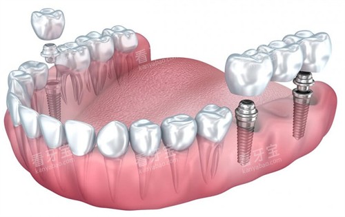 单颗烤瓷牙和连冠种植牙 单颗烤瓷牙和连冠种植牙