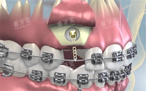 翻瓣牙齿牵引 翻瓣牙齿牵引