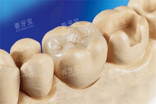 补牙嵌体修复结果 补牙嵌体修复结果