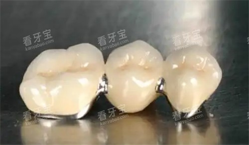 牙冠照片 牙冠照片