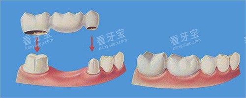 假牙牙冠示意图 假牙牙冠示意图
