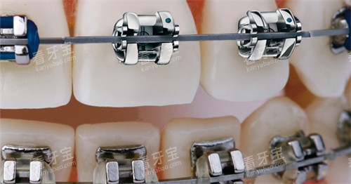 3M自锁矫正器佩戴展示 3M自锁矫正器佩戴展示