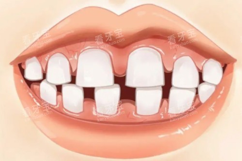 牙齿牙缝大 牙齿牙缝大