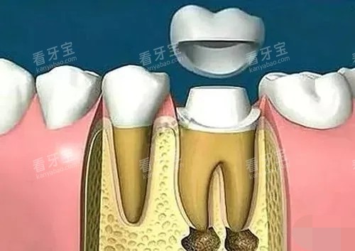 根管治疗后带牙冠 根管治疗后带牙冠