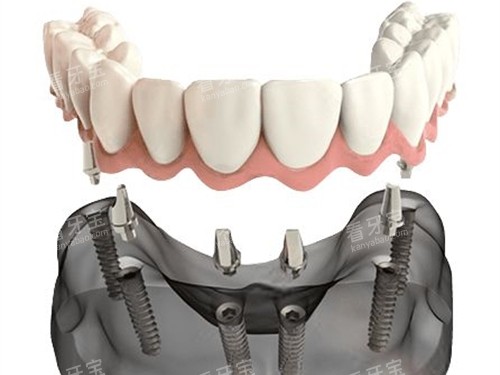 半口种植牙联排牙冠安装示意图 半口种植牙联排牙冠安装示意图
