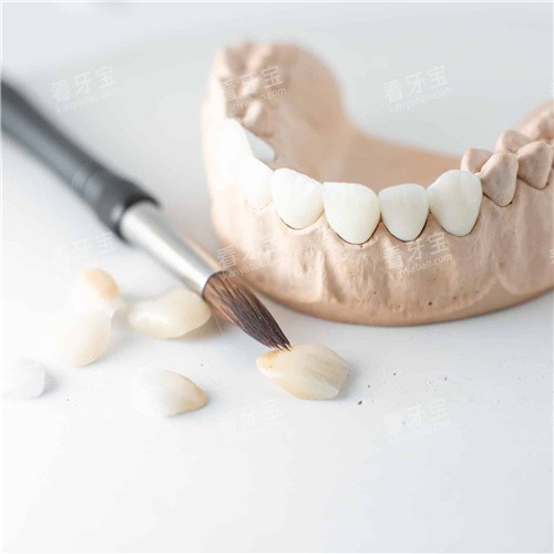 牙齿贴面成品图 牙齿贴面成品图