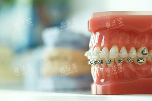 牙齿矫正牙套模型展示图 牙齿矫正牙套模型展示图