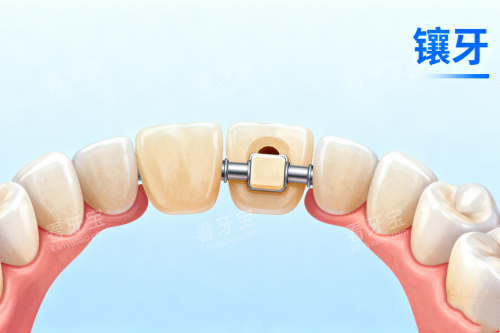 镶牙与正常牙齿对比图 镶牙与正常牙齿对比图