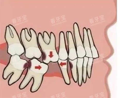 牙齿缺牙照片 牙齿缺牙照片