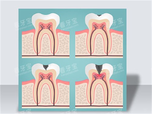 不保护牙齿的危害 不保护牙齿的危害