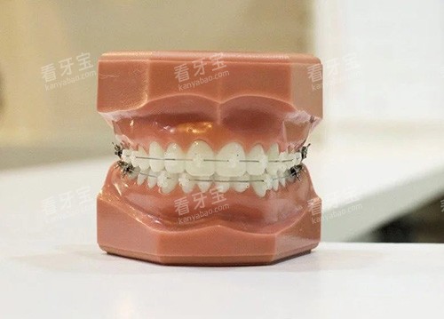 牙齿矫正陶瓷托槽牙套模型 牙齿矫正陶瓷托槽牙套模型
