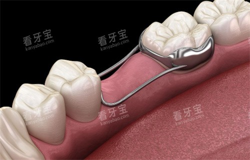 牙齿间隙保持器 牙齿间隙保持器