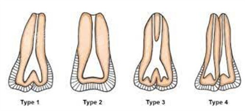 正常牙齿和双生牙 正常牙齿和双生牙