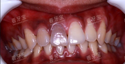 牙齿龋坏表现图 牙齿龋坏表现图