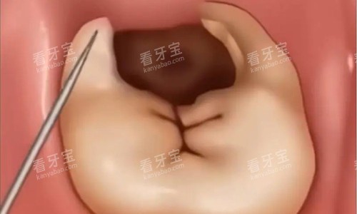 牙齿龋齿卡通图 牙齿龋齿卡通图