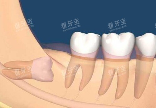 牙齿阻生智齿卡通图 牙齿阻生智齿卡通图