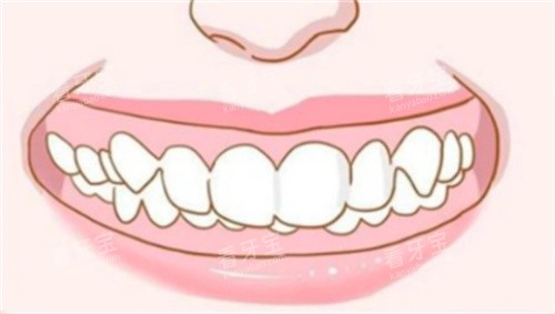 深覆合的样子 深覆合的样子