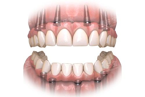 all-on-6全口种植牙示意图 all-on-6全口种植牙示意图