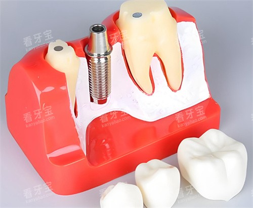 牙齿模型种植体 牙齿模型种植体