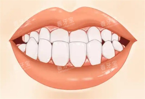 地包天正面 地包天正面