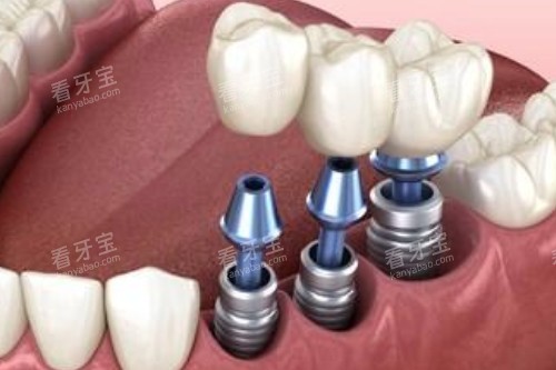 种植牙卡通图展示 种植牙卡通图展示