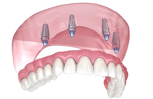 种植牙动画示意图片 种植牙动画示意图片