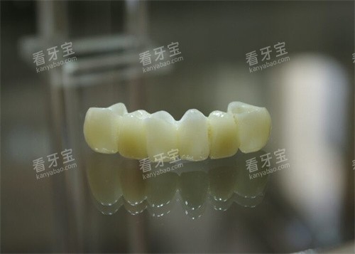 爱尔创全瓷牙连冠实物展示图 爱尔创全瓷牙连冠实物展示图