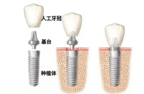 种植牙的结构 种植牙的结构