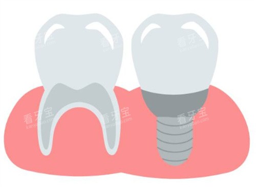 种植牙和牙齿图 种植牙和牙齿图