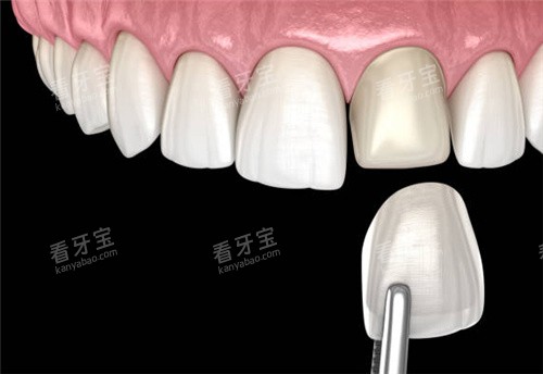 单颗牙齿贴面图 单颗牙齿贴面图