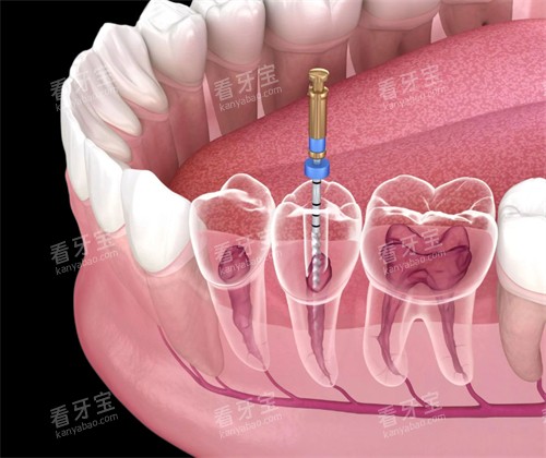 根管治疗修复坏牙 根管治疗修复坏牙