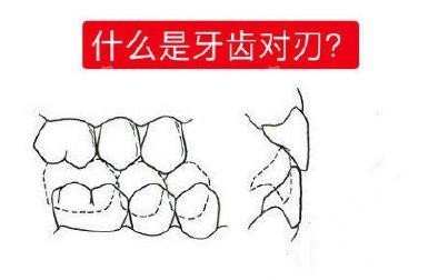 什么是牙齿对刃 什么是牙齿对刃
