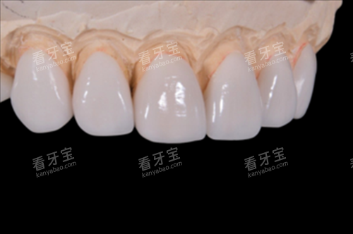 牙齿贴面修复展示 牙齿贴面修复展示