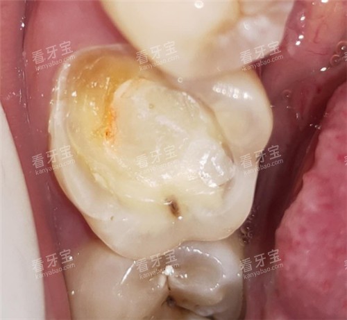 牙齿龋坏清理图 牙齿龋坏清理图