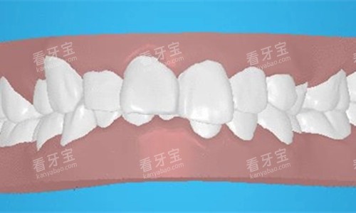 牙齿深覆合卡通图 牙齿深覆合卡通图