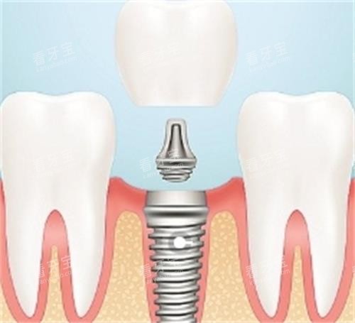 种植牙的组成部分 种植牙的组成部分