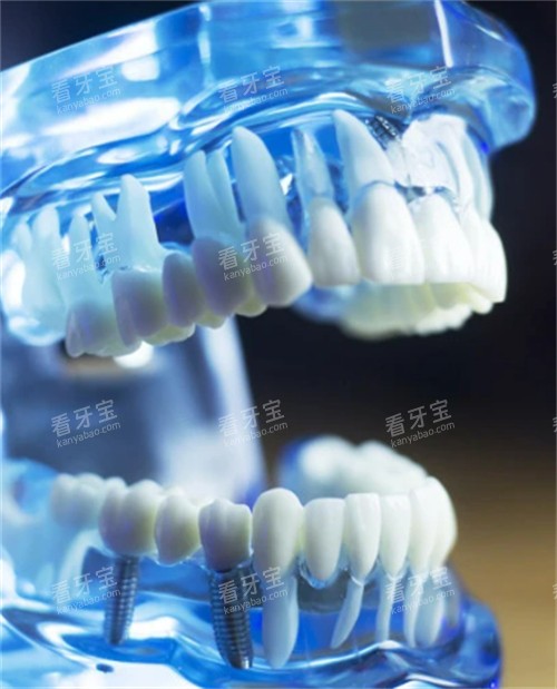 种植牙模型图示 种植牙模型图示