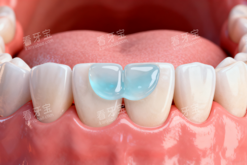 牙齿涂氟卡通图 牙齿涂氟卡通图