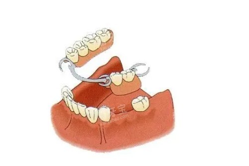 7活动假牙佩戴模型图 7活动假牙佩戴模型图